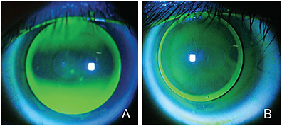 Contact Lens Spectrum Pentavision