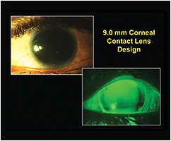 Contact Lens Spectrum | PentaVision