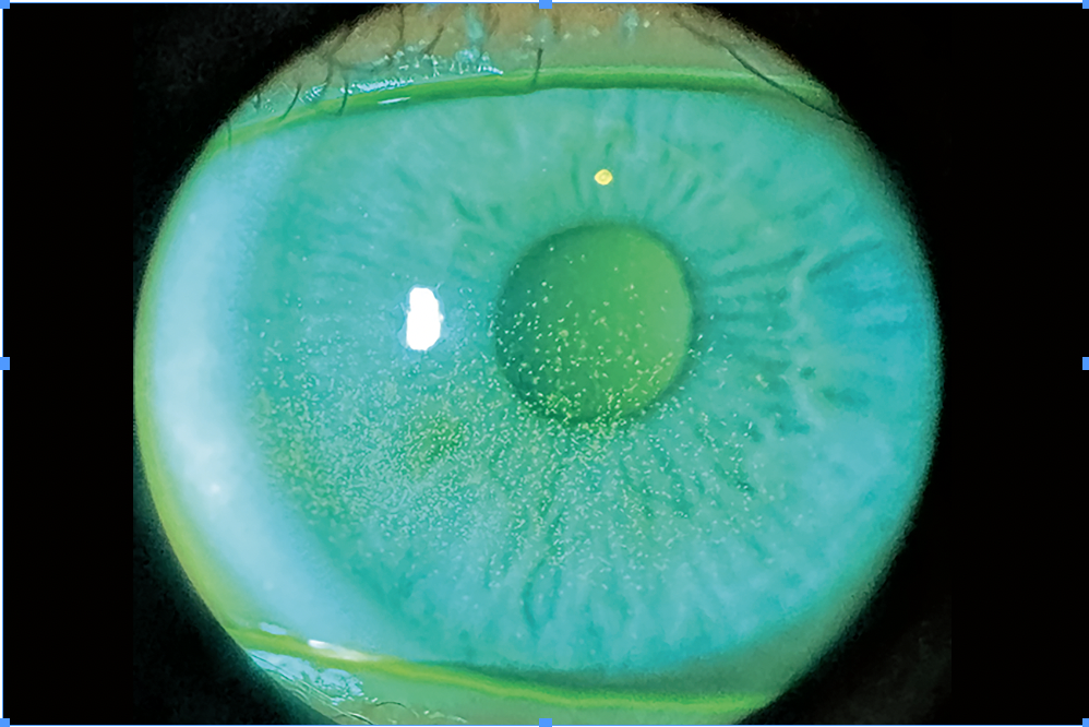 Superficial Punctate Keratitis