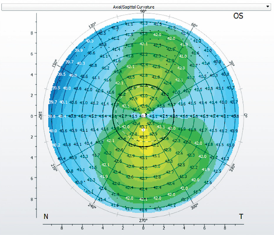 Figure 1. A topography map showing limbus-to-limbus astigmatism that would require a toric ortho-k lens.