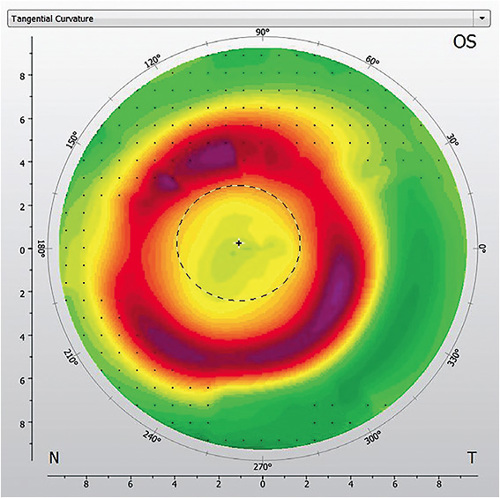 FIGURE 1. Small treatment zone inducing significant peripheral blur.