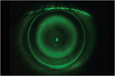 Figure 2. Image of a well-centered ortho-k lens demonstrating the desired bull’s-eye pattern.