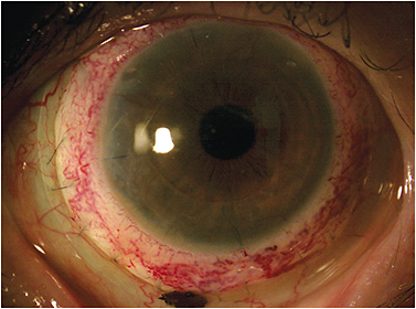 Figure 6. Scleral GP lenses are used for treatment of advanced ocular surface disease, such as graft-versus-host disease.