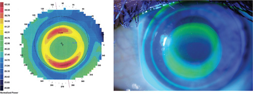 FIGURE 3. A decentered lens. This type of fit may generate more defocus and contribute to better management. However, impact on distance vision must be strongly evaluated.