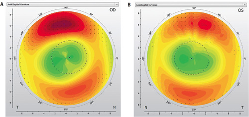 FIGURE 4. Mild residual cylinder after a few weeks of orthokeratology lens wear.