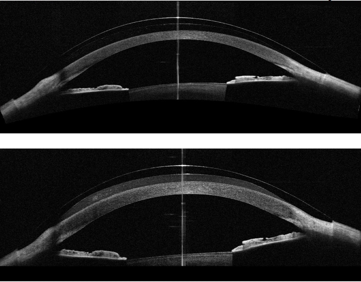 CL Leaders Present Insights on the Modern Era of Scleral Lenses ...