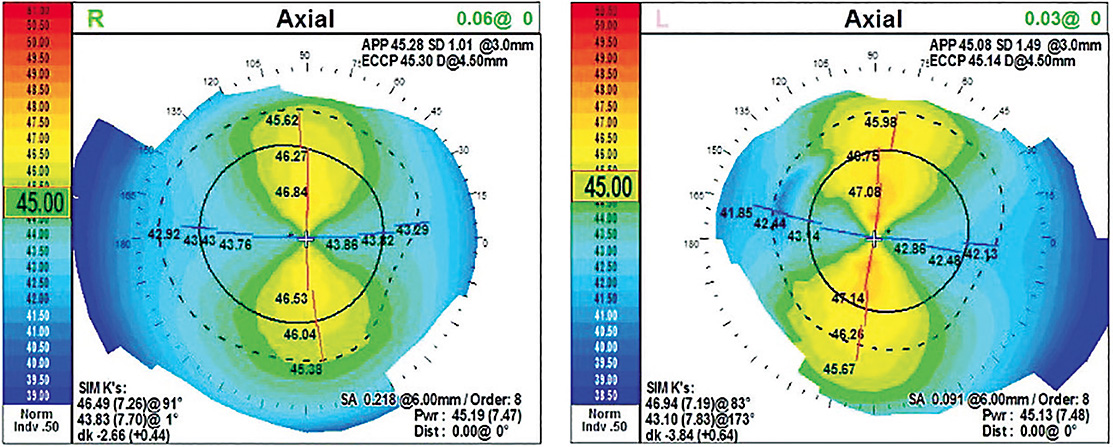 Figure 4. Normal corneal topographical maps of a highly astigmatic patient.