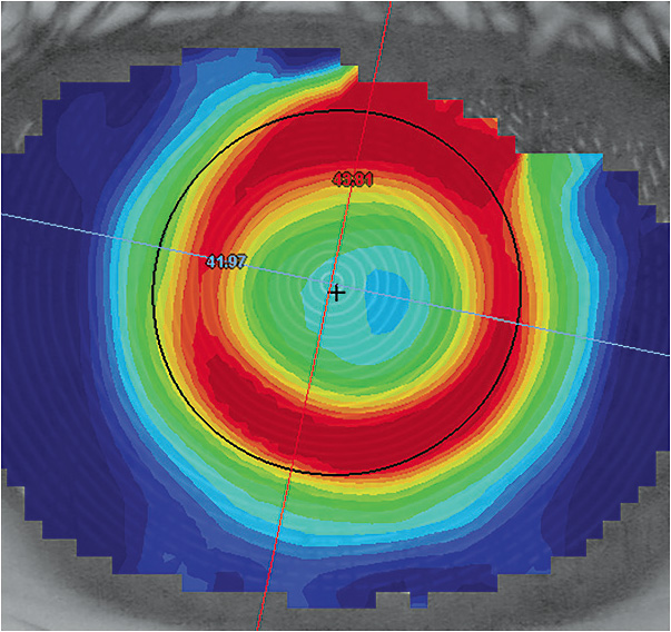 Figure 2. Toric ortho-k lenses will result in better lens centration and treatment for myopia control on astigmatic corneas.
