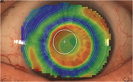 FIGURE 4. A topography performed over the surface of a multifocal scleral lens, showing misalignment of the lens optics and the patient’s visual axis.