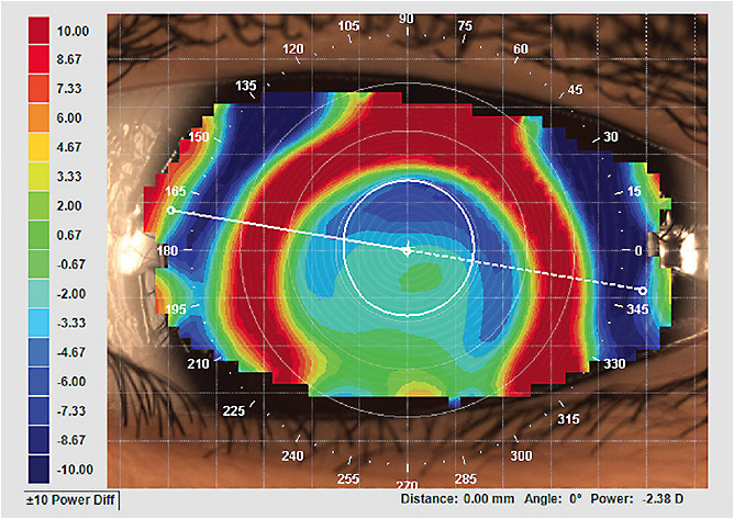 Figure 1. Inferior decentration pattern with the first lens.Photos courtesy of John Mark Jackson, OD, MS.