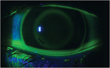 FIGURE 3. Well-fitting orthokeratology lens with toric peripheral curve radii.