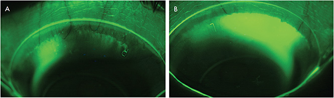 Figure 5 (A) Leakage of tear debris into the fluid chamber under a right scleral lens. (B) Leakage of tear debris into the fluid chamber under a left scleral lens.