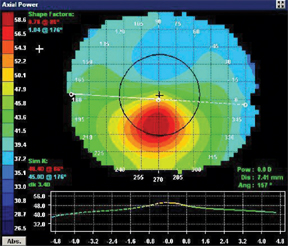 Contact Lens Spectrum | PentaVision