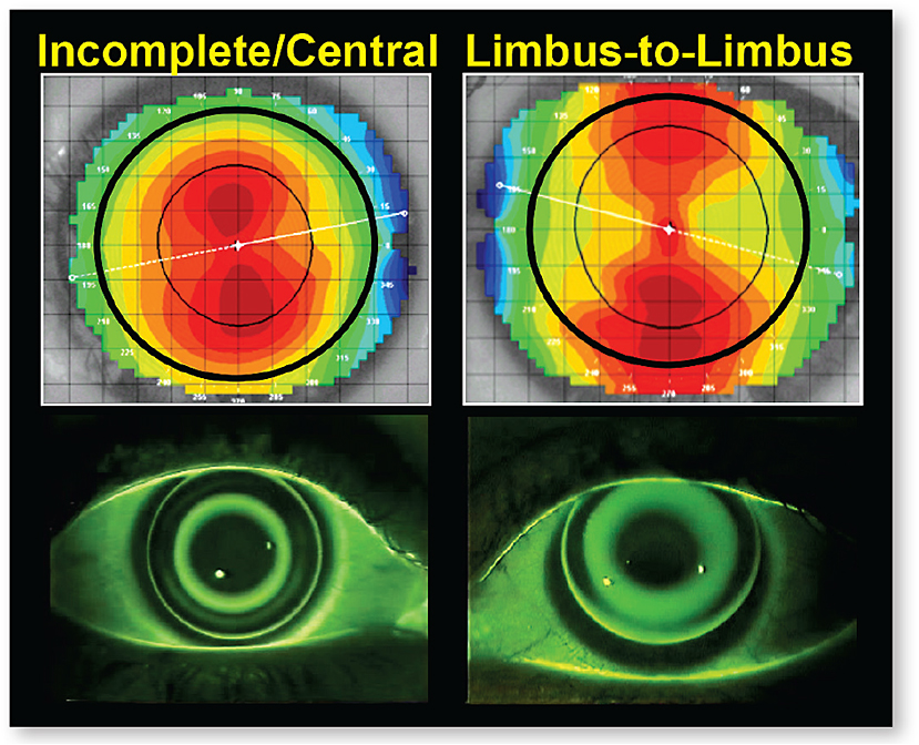 Contact Lens Spectrum PentaVision