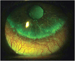 Figure 1. Paralimbal staining, neovascularization, and edema after SL removal.