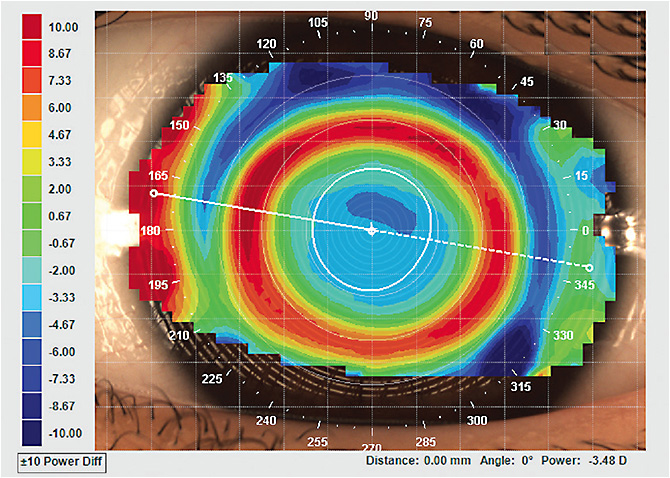 Figure 2. Well-centered treatment with the second lens. Photos courtesy of John Mark Jackson, OD, MS.