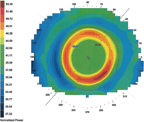 FIGURE 2. Topography of the same cornea, refitted with a custom-design ortho-k lens. The red ring is now fully within the pupil area, leaving a sufficient central flat area so that distance vision is not affected.