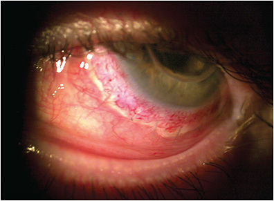 FIGURE 1. Conjunctival chemosis is a common ocular sign in allergic conjunctivitis.