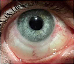 Figure 3. Compression ring and rebound injection after four hours of SL removal.