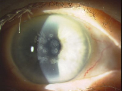 Figure 2. Cornea of the patient’s mother.