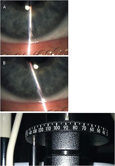 Figure 3. (A) Orientation marking on a soft toric contact lens with slit lamp beam vertically at 90º. The marking is rotated to the right from the examiners’ perspective. (B) The orientation of the slit lamp beam is rotated to align with the rotation of the lens marking. (C) The amount of rotation can be noted from the rotation scale on the slit lamp light tower.