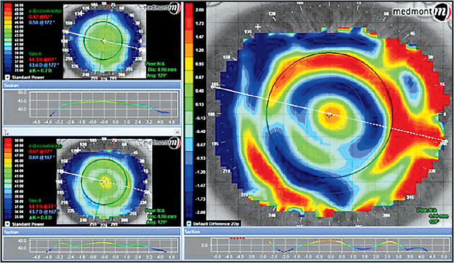 Contact Lens Spectrum | PentaVision