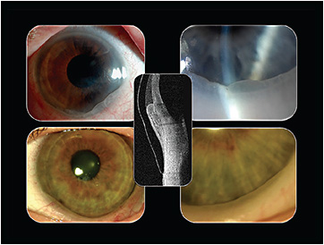 Figure 1. In susceptible patients, a prolapse of the conjunctiva can occur beneath their scleral lenses.