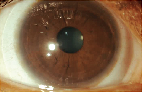 Figure 4. Improved corneal coverage and centration utilizing a custom soft lens.