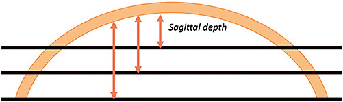 Figure 1. The size of the cornea directly impacts the sagittal depth of the cornea.