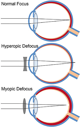 Contact Lens Spectrum | PentaVision