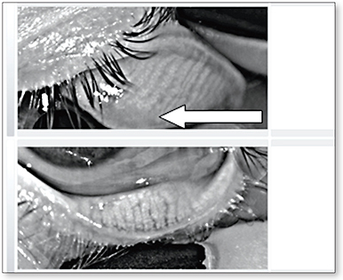 Contact Lens Spectrum | PentaVision