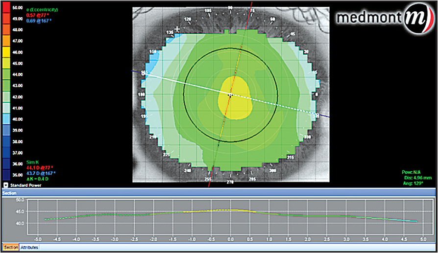Contact Lens Spectrum | PentaVision