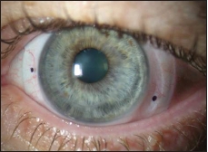 Contact Lens Spectrum | PentaVision