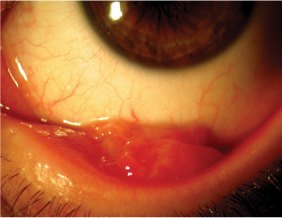 Contact Lens Spectrum | PentaVision