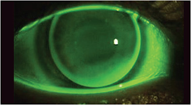 FIGURE 3. Fluorescein pattern of a patient who has low to moderate astigmatism and who is wearing a 9.2mm diameter lens that sits just under the upper lid. The tilting effect from the lid creates the slight increase in visibility of fluorescein in the inferior quadrant where the cornea is steeper.