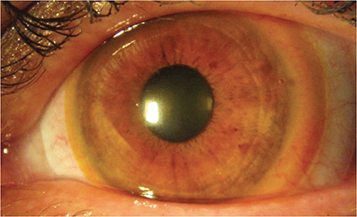 Contact Lens Spectrum | PentaVision