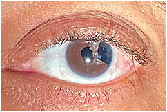 Figure 1. A 57-year-old suffering from significant photophobia and glare from iris defect due to complication from cataract surgery that also resulted in a retinal detachment and aphakia.Photos courtesy of Tiffany Andrzejewski, OD