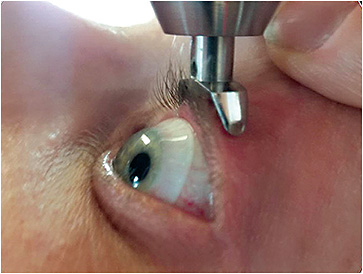 Figure 2.  The Diaton instrument allows measurement of IOP during scleral lens wear.