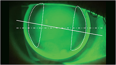 Fluorescein pattern of a patient who has moderate astigmatism and who is wearing a 9.2mm diameter lens that is fit steeper than the flat keratometry reading (horizontal) and just barely steeper than the vertical meridian. The resulting bearing areas in the horizontal midperiphery create a characteristic “Double D” pattern as outlined in the dotted lines. The irregular dashed line across the midline indicates the horizontal axis (180°) and the solid line indicates the axis of the corneal astigmatism (165°).