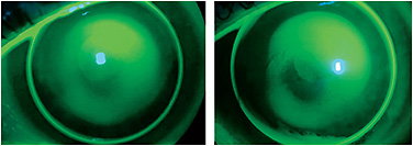 Contact Lens Spectrum | PentaVision