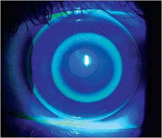 Figure 2. Bull&amp;#x2019;s-eye fluorescein pattern showing an ideal fit for an ortho-k lens.