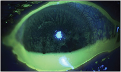 Contact Lens Spectrum | PentaVision