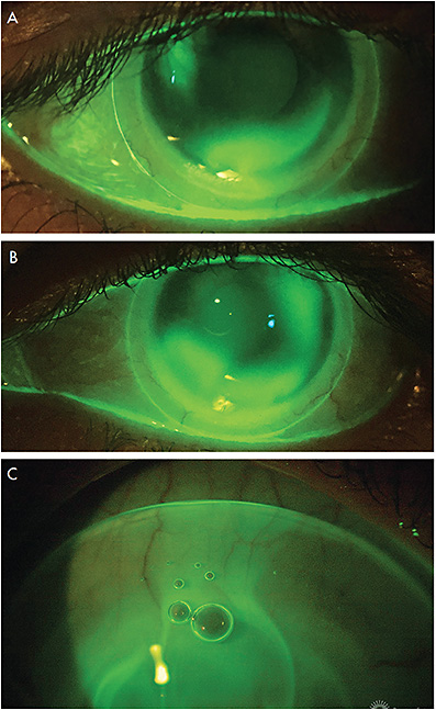 Contact Lens Spectrum | PentaVision